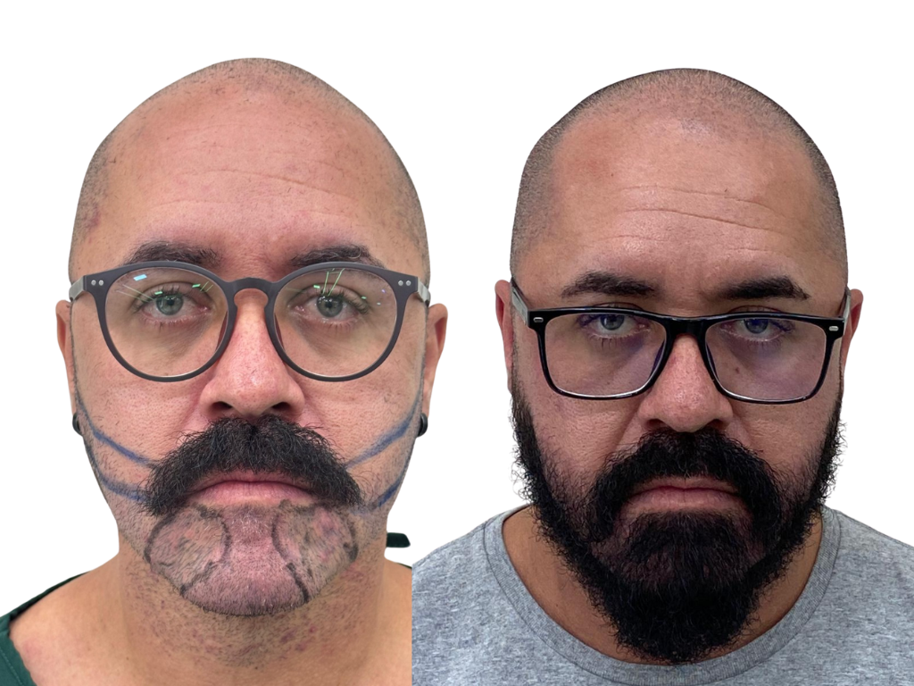 Antes e depois de Transplante de Barba na Yourmed