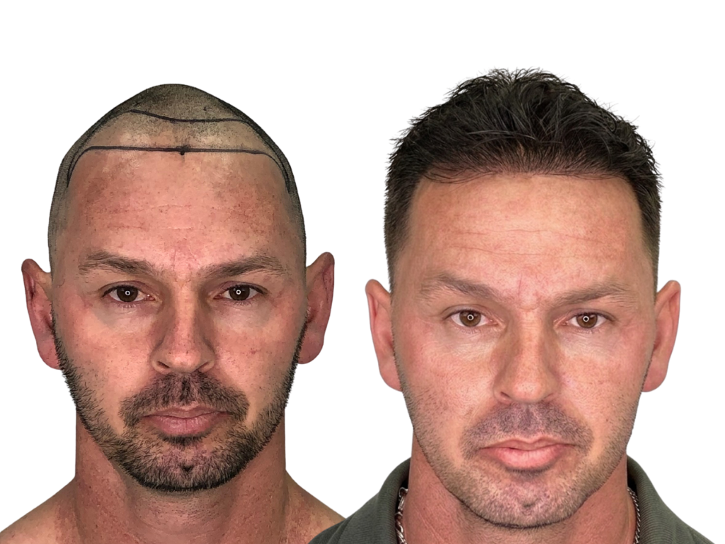 Antes e depois de Transplante Capilar na Yourmed