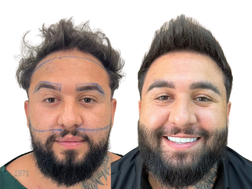 Antes e depois de Transplante de Barba, Capilar e Sobrancelha na Yourmed