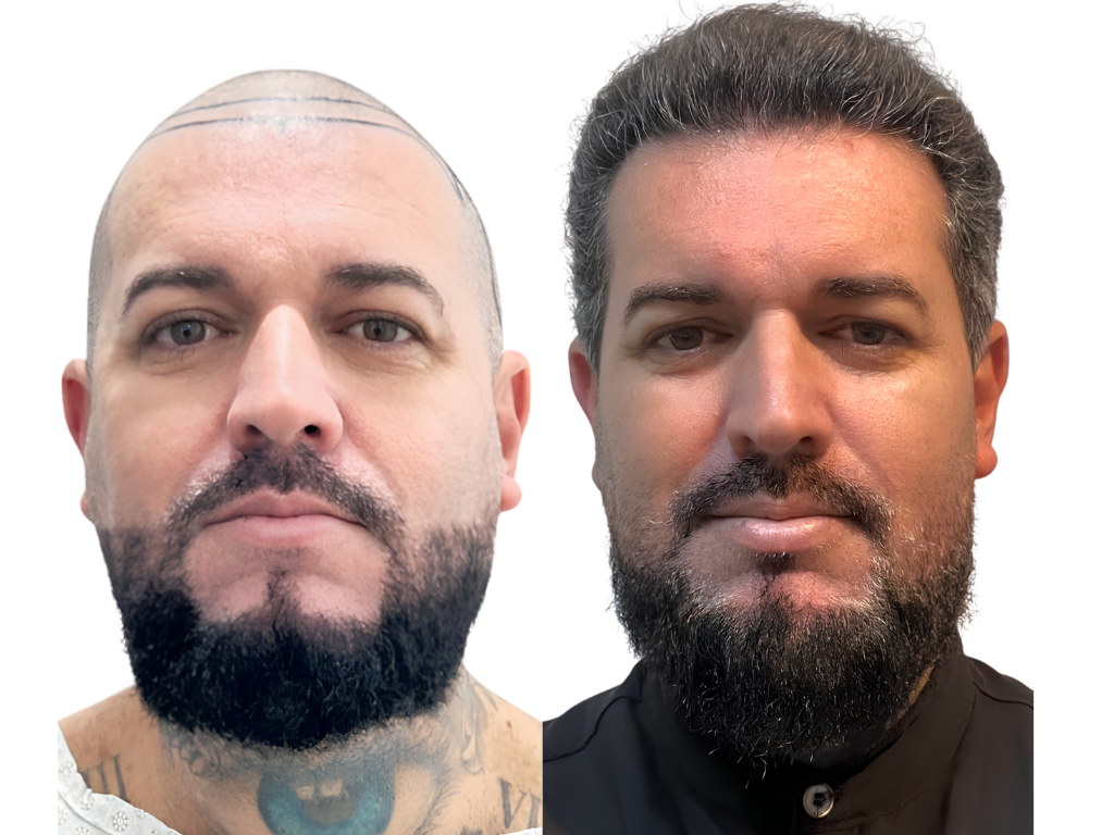 Antes e depois de Transplante Capilar na Yourmed