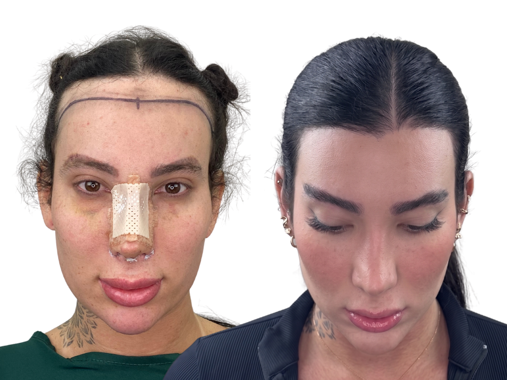 Antes e depois de Transplante Capilar e Sobrancelha na Yourmed