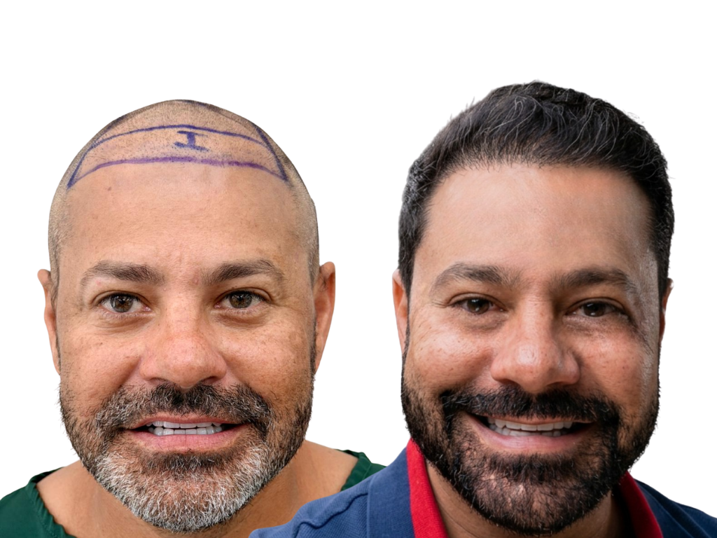 Antes e depois de Transplante Capilar na Yourmed